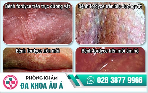 Fordyce là bệnh gì?